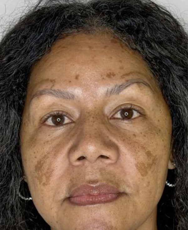 Before - Pigmentation