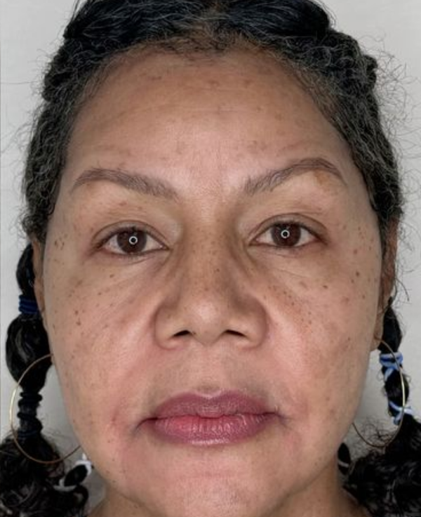 After - Pigmentation