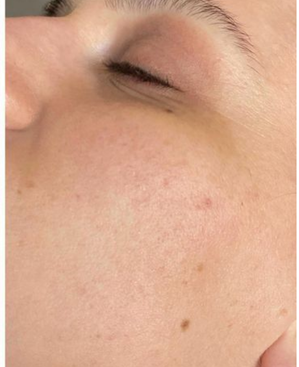 After - Acne