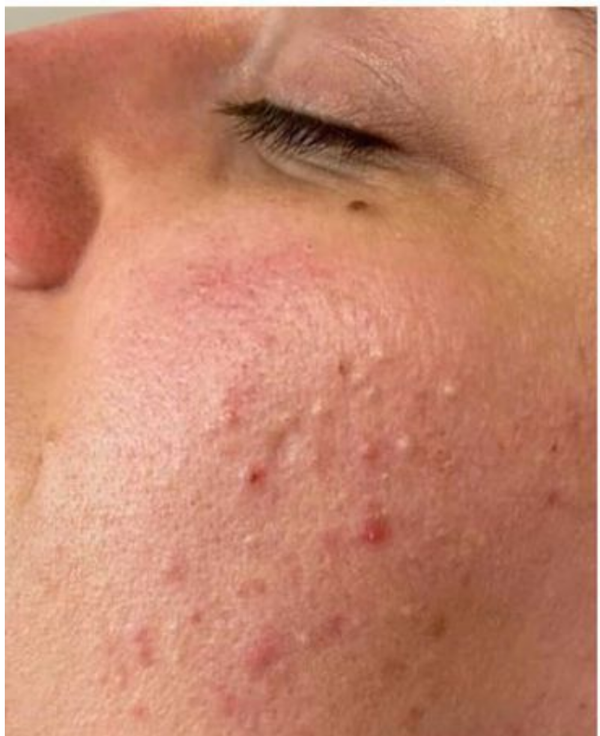 Before - Acne