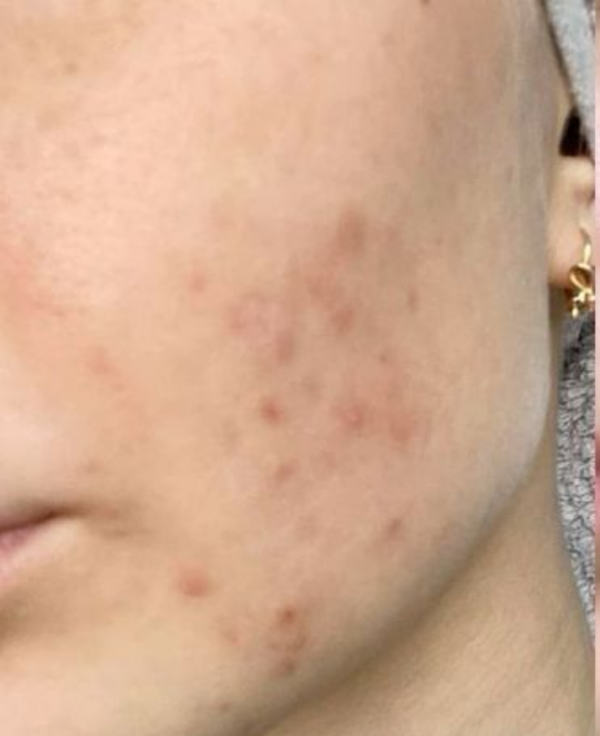 Before - Dull & Tired Skin