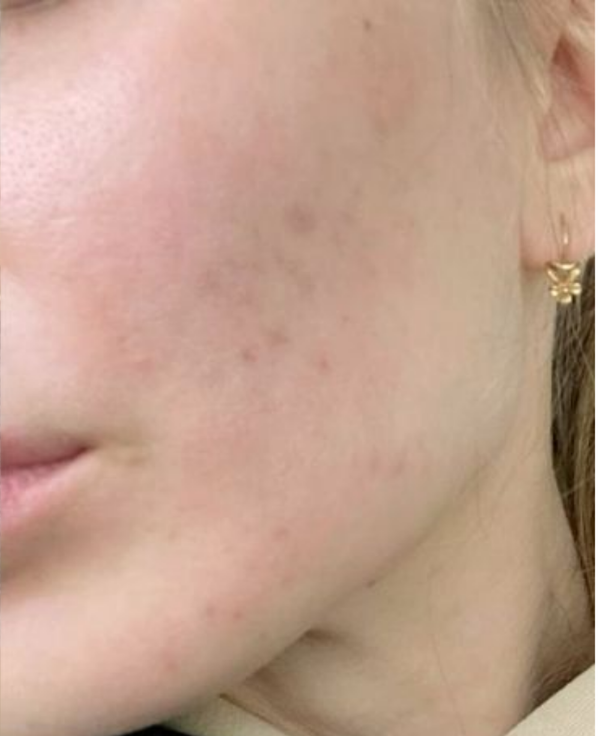 After - Dull & Tired Skin