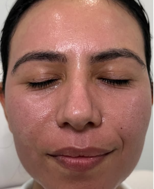 Before - Dull Skin