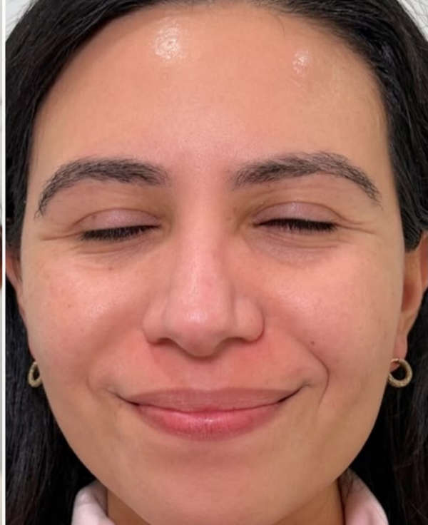 After - Dull Skin